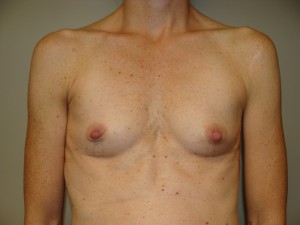 Breast Augmentation Before and After 25 | Sanjay Grover MD FACS