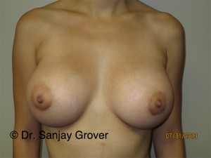 Breast Augmentation Before and After | Sanjay Grover MD FACS