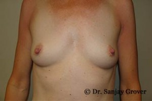 Breast Augmentation Before and After 220 | Sanjay Grover MD FACS