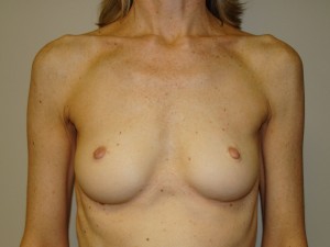 Breast Augmentation Before and After 255 | Sanjay Grover MD FACS