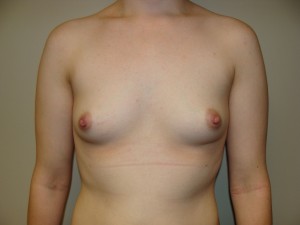 Breast Augmentation Before and After 164 | Sanjay Grover MD FACS