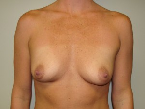 Breast Augmentation Before and After 97 | Sanjay Grover MD FACS