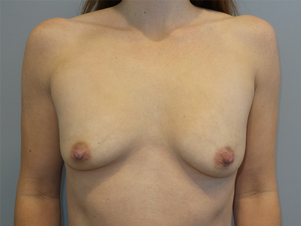 Breast Augmentation Before and After 86 | Sanjay Grover MD FACS