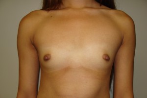 Breast Augmentation Before and After 97 | Sanjay Grover MD FACS