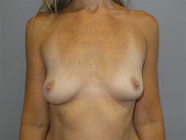 Breast Augmentation Before and After 02 | Sanjay Grover MD FACS