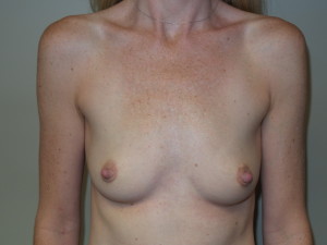 Breast Augmentation Before and After 250 | Sanjay Grover MD FACS