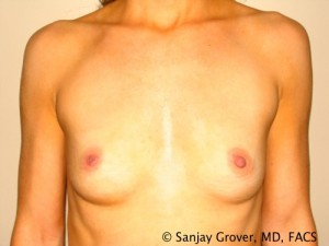 Breast Augmentation Before and After 288 | Sanjay Grover MD FACS