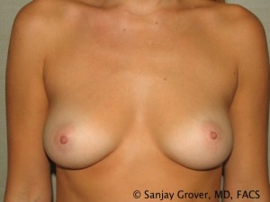 Breast Augmentation Before and After 220 | Sanjay Grover MD FACS