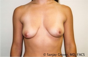 Breast Augmentation Before and After 176 | Sanjay Grover MD FACS