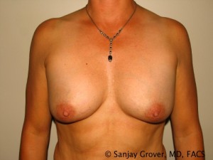 Breast Augmentation Before and After 01 | Sanjay Grover MD FACS