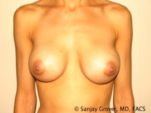 Breast Augmentation Before and After 86 | Sanjay Grover MD FACS