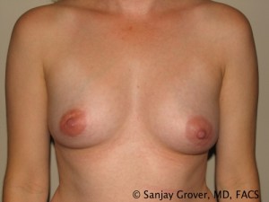 Breast Augmentation Before and After 61 | Sanjay Grover MD FACS