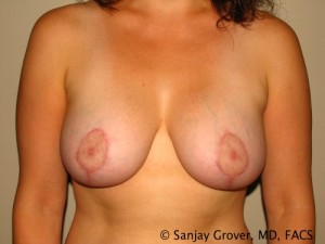 Breast Lift Before and After | Sanjay Grover MD FACS