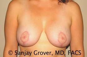 Breast Lift Before and After | Sanjay Grover MD FACS