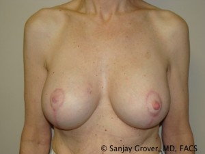 Breast Lift Before and After | Sanjay Grover MD FACS