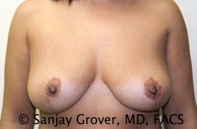 Breast Reduction Before and After | Sanjay Grover MD FACS