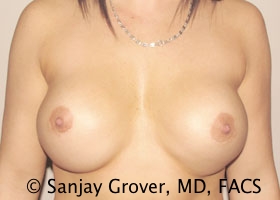 Breast Revision Before and After | Sanjay Grover MD FACS