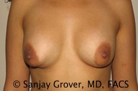 Breast Revision Before and After 51 | Sanjay Grover MD FACS