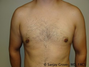 Gynecomastia Before and After | Sanjay Grover MD FACS