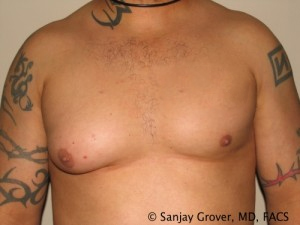 Gynecomastia Before and After 01 | Sanjay Grover MD FACS