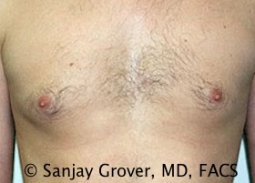 Gynecomastia Before and After 01 | Sanjay Grover MD FACS