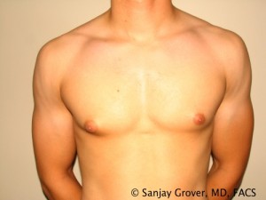 Gynecomastia Before and After 15 | Sanjay Grover MD FACS