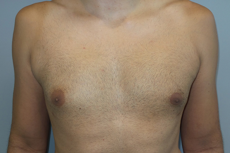 Gynecomastia Before and After | Sanjay Grover MD FACS