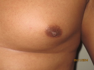 Nipple Reduction Before and After 02 | Sanjay Grover MD FACS