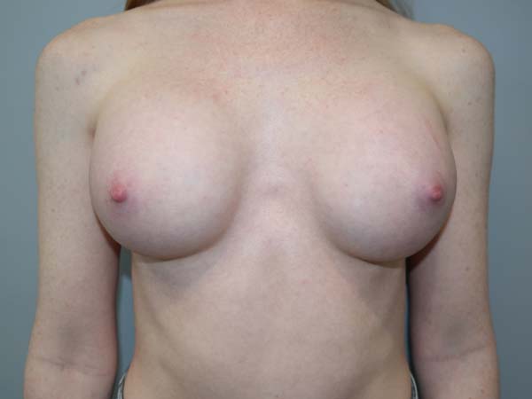 Scarless Breast Augmentation Before and After | Sanjay Grover MD FACS