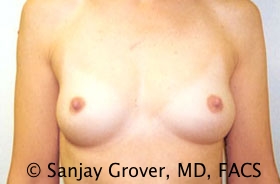 Scarless Breast Augmentation Before and After | Sanjay Grover MD FACS