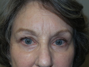 Blepharoplasty Before and After | Sanjay Grover MD FACS