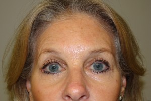 Blepharoplasty Before and After 18 | Sanjay Grover MD FACS