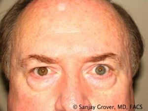 Blepharoplasty Before and After 26 | Sanjay Grover MD FACS