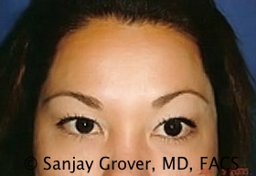 Blepharoplasty Before and After | Sanjay Grover MD FACS