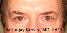 Blepharoplasty Before and After | Sanjay Grover MD FACS