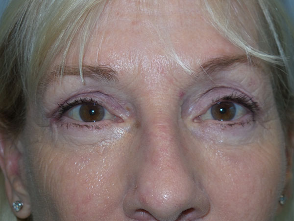 Blepharoplasty Before and After 36 | Sanjay Grover MD FACS