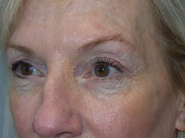 Blepharoplasty Before and After 36 | Sanjay Grover MD FACS