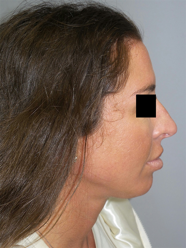 Chin Augmentation Before and After 02 | Sanjay Grover MD FACS