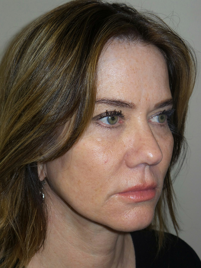 Facelift Before and After | Sanjay Grover MD FACS