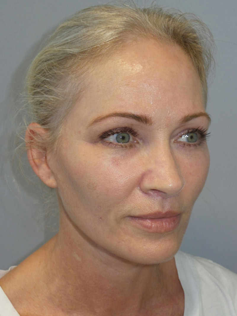 Facelift Before and After 08 | Sanjay Grover MD FACS