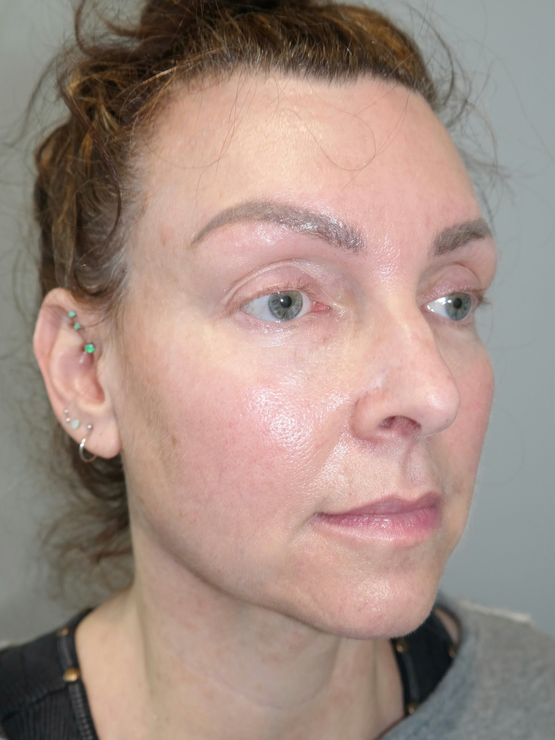 Facelift Before and After 02 | Sanjay Grover MD FACS