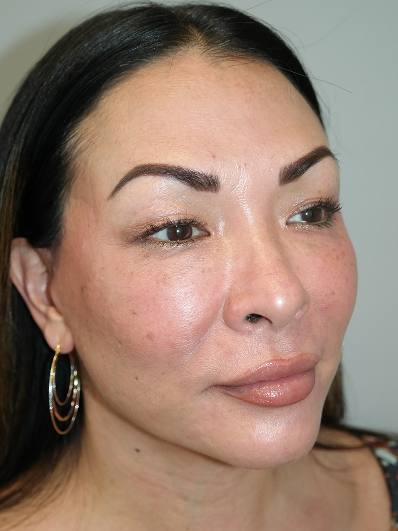 Facelift Before and After 13 | Sanjay Grover MD FACS