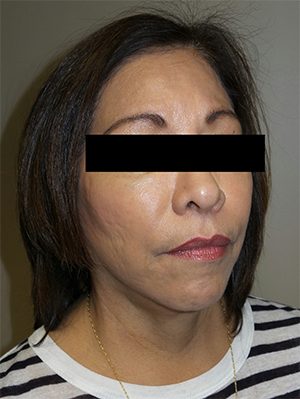 Facelift Before and After 18 | Sanjay Grover MD FACS