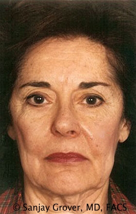 Facelift Before and After 18 | Sanjay Grover MD FACS