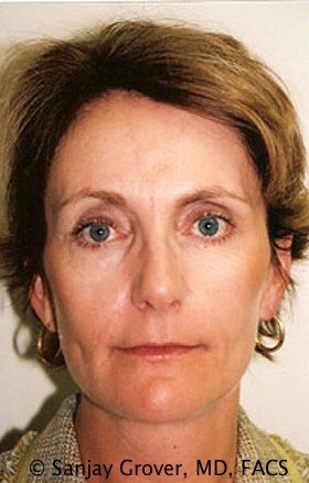 Facelift Before and After | Sanjay Grover MD FACS