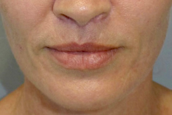 Lip Lift Before and After | Sanjay Grover MD FACS