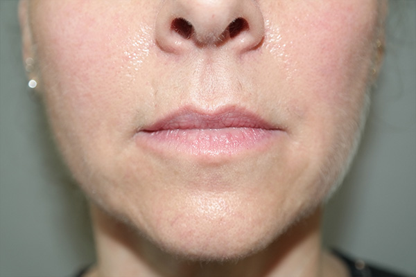 Lip Lift Before and After 06 | Sanjay Grover MD FACS