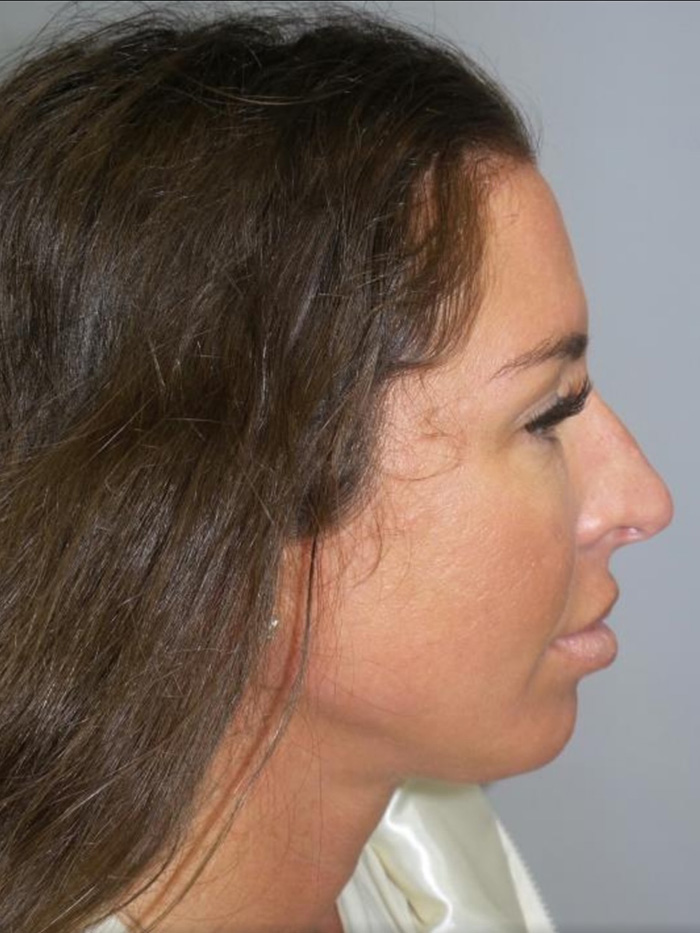 Rhinoplasty Before and After 38 | Sanjay Grover MD FACS
