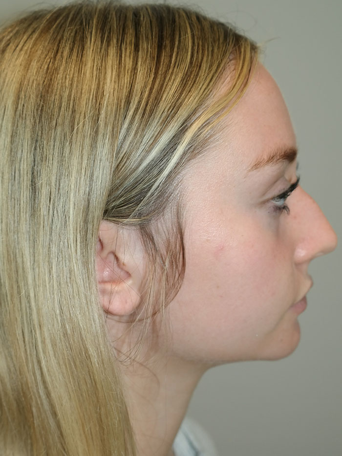 Rhinoplasty Before and After 03 | Sanjay Grover MD FACS