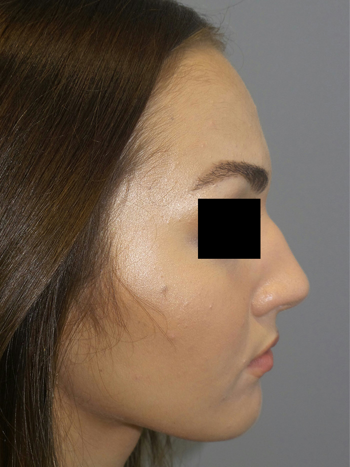 Rhinoplasty Before and After 49 | Sanjay Grover MD FACS